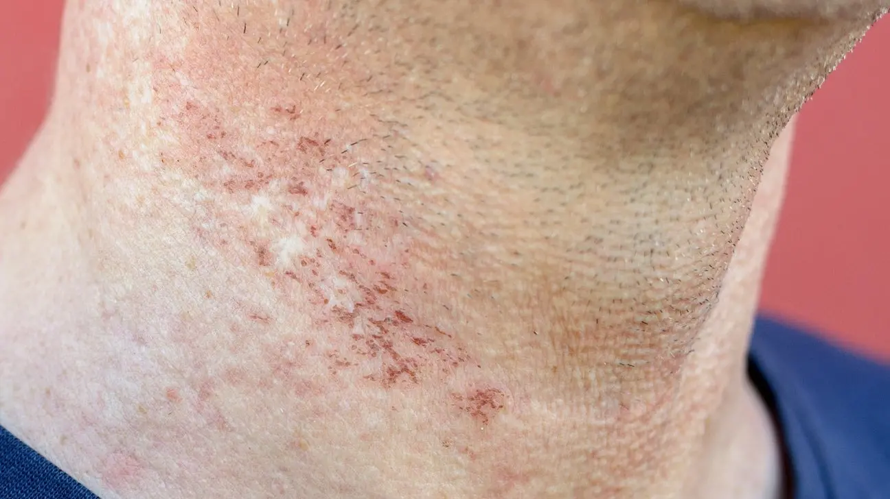 سوختگی ناشی از لیزر موهای زائد