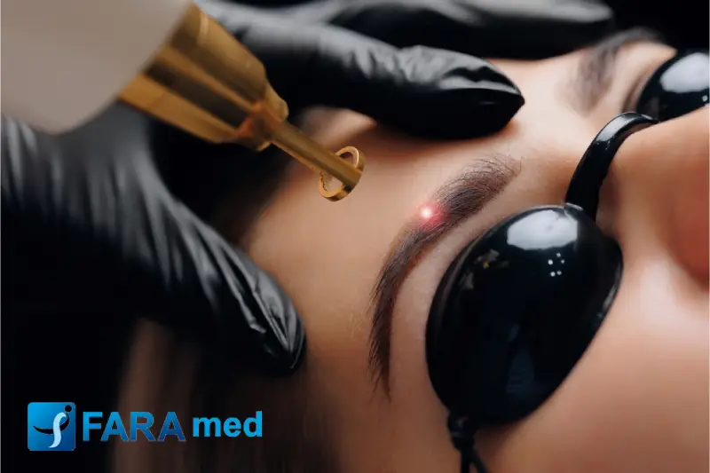 پیکوثانیه یا کیوسوئیچ؟ مقایسه جامع دو تکنولوژی برتر برای ریموال تتو