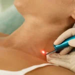 پیکوثانیه یا کیوسوئیچ؟ مقایسه جامع دو تکنولوژی برتر برای ریموال تتو