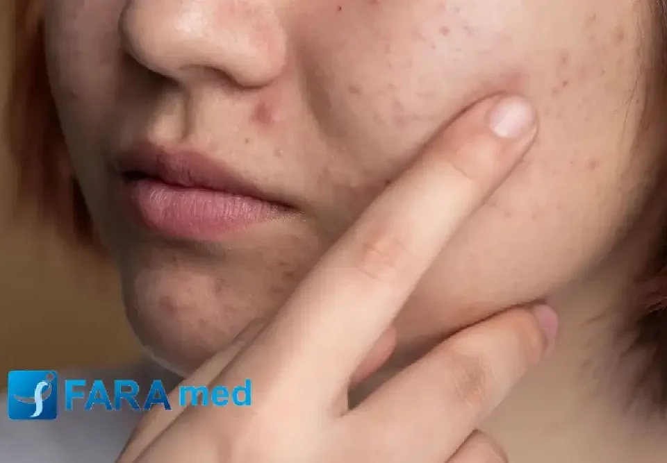 فولیکولیت پس از لیزر: یک پروتکل بالینی برای پیشگیری و درمان