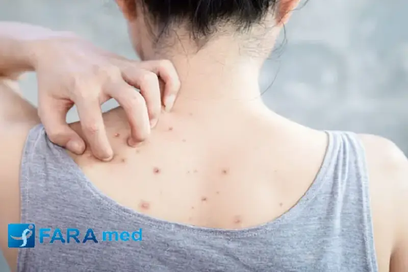 فولیکولیت پس از لیزر