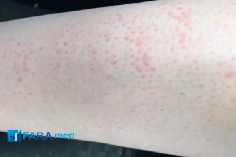 فولیکولیت پس از لیزر