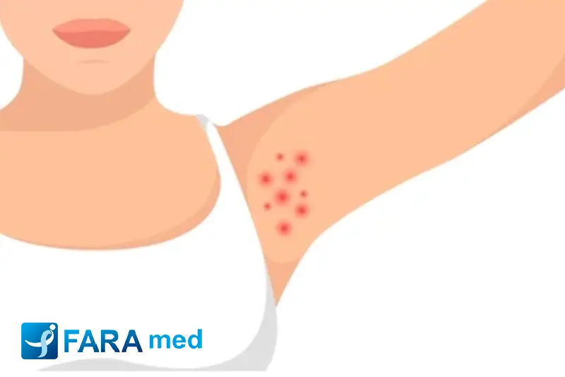 فولیکولیت پس از لیزر