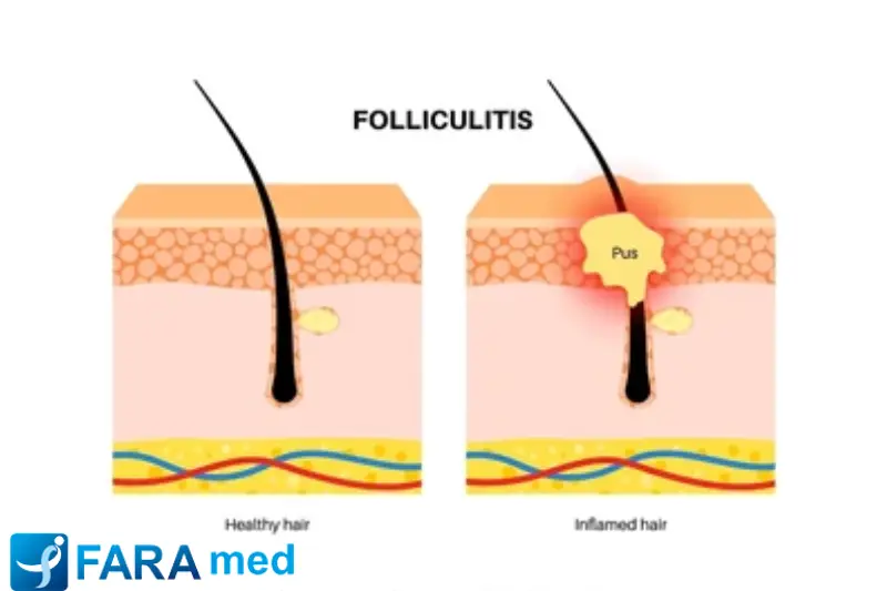 فولیکولیت پس از لیزر