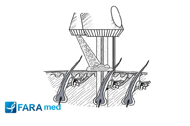 تحلیل بازگشت سرمایه در زیبایی: آنالیز هزینه – فایده تکنولوژیهای خنک کننده لیزر