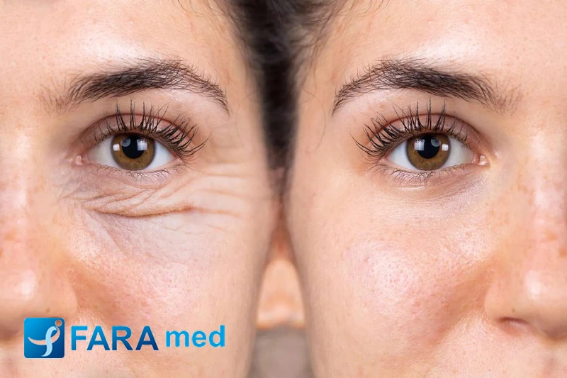 لیزر اربیوم صورت