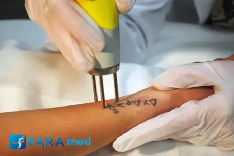 نتایج لیزر تتو ریموال