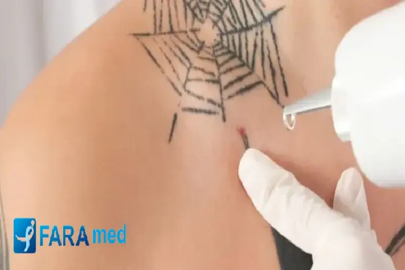 نتایج لیزر تتو ریموال