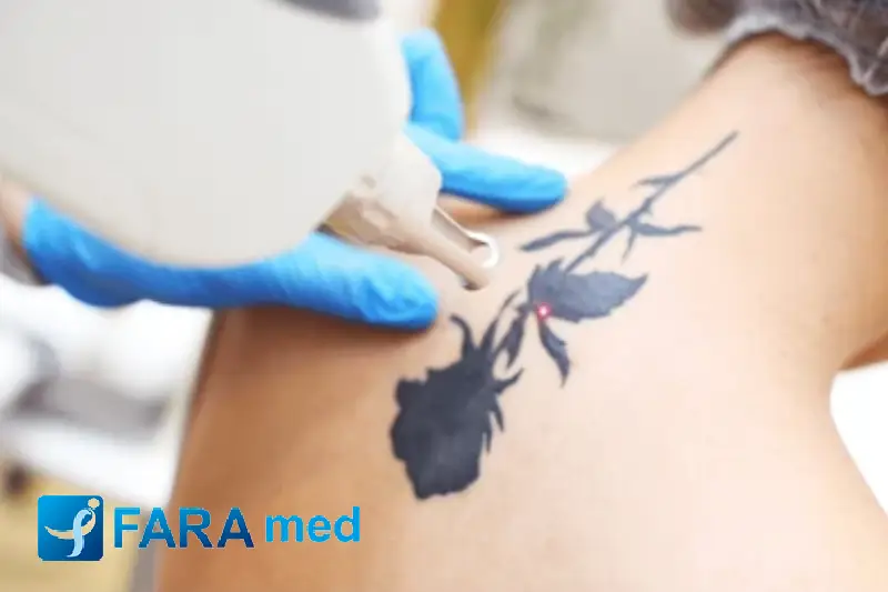 نتایج لیزر تتو ریموال