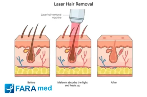 لیزر مو های زائد