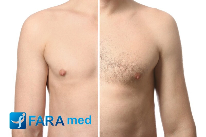 نکات قبل از لیزر فول بادی