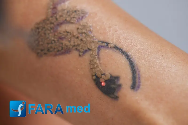 بهترین روش های پاک کردن تتو