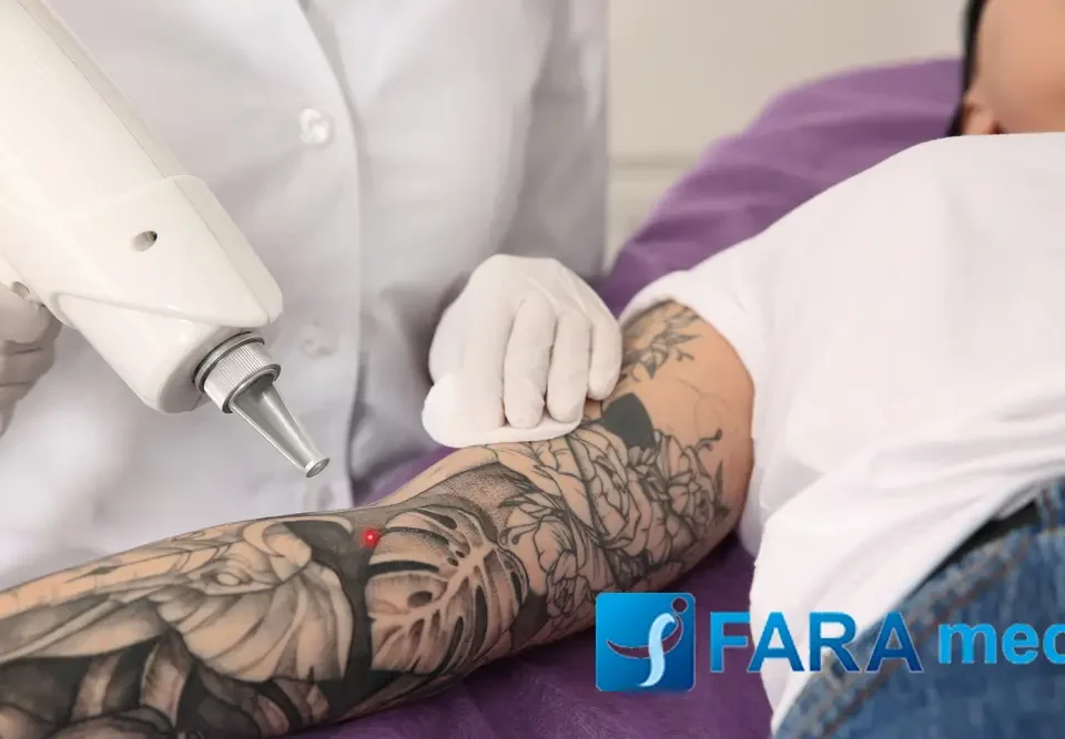 بهترین روش های پاک کردن تتو