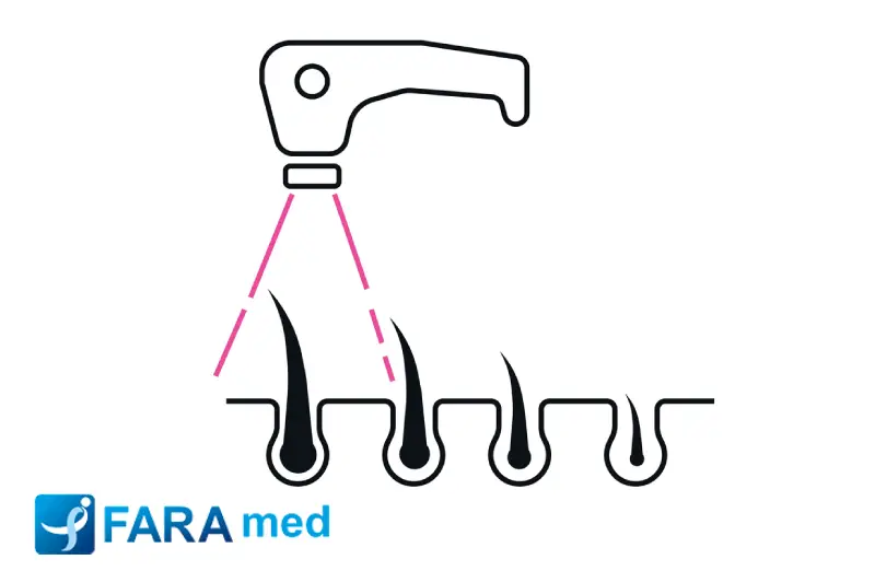 لیزر بار چیست