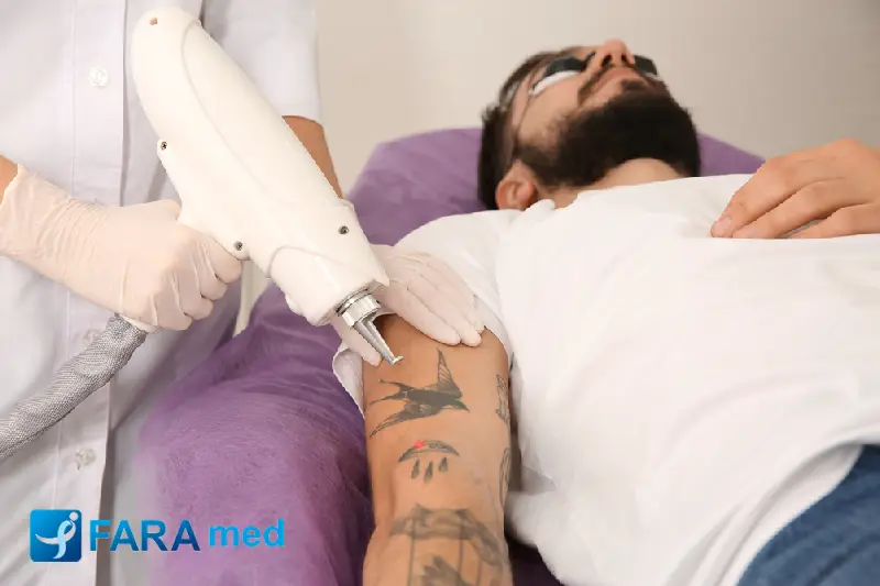 بهترین لیزر برای پاک کردن تتو چیست