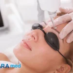 بهترین لیزر برای پاک کردن تتو چیست