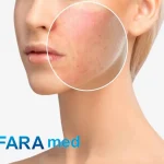 بهترین کرم برای جای سوختگی لیزر