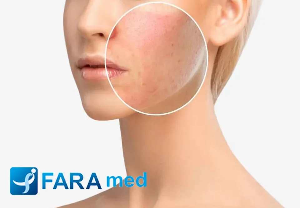 بهترین کرم برای جای سوختگی لیزر