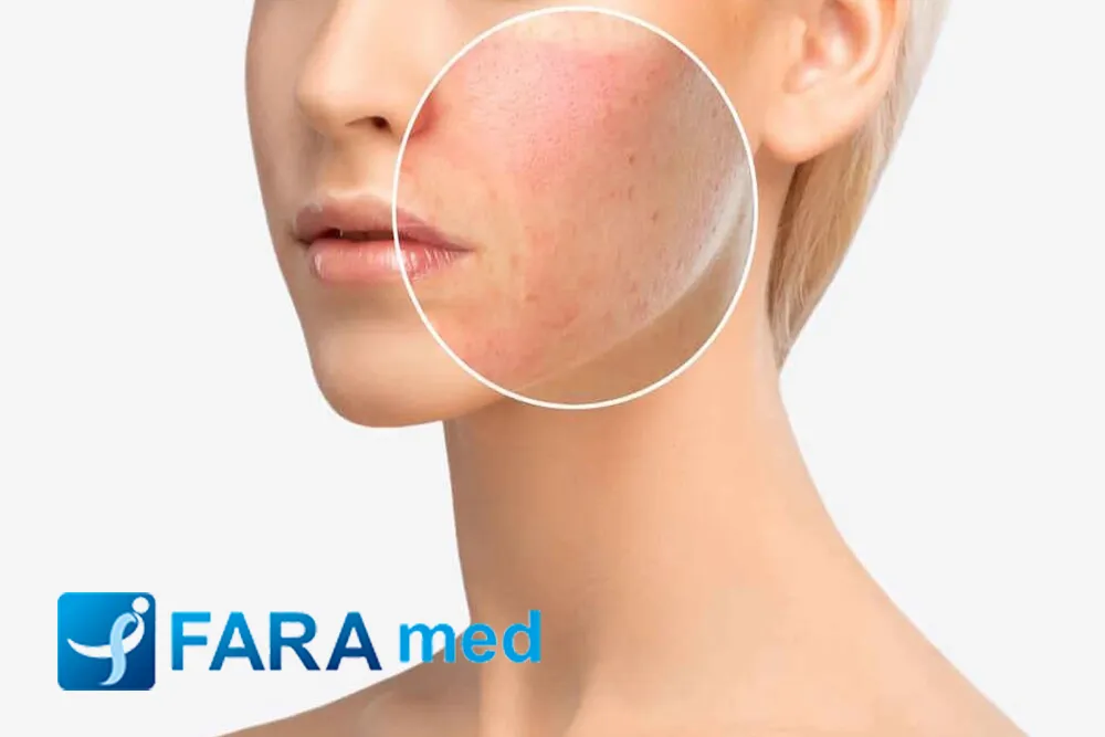 بهترین کرم برای جای سوختگی لیزر